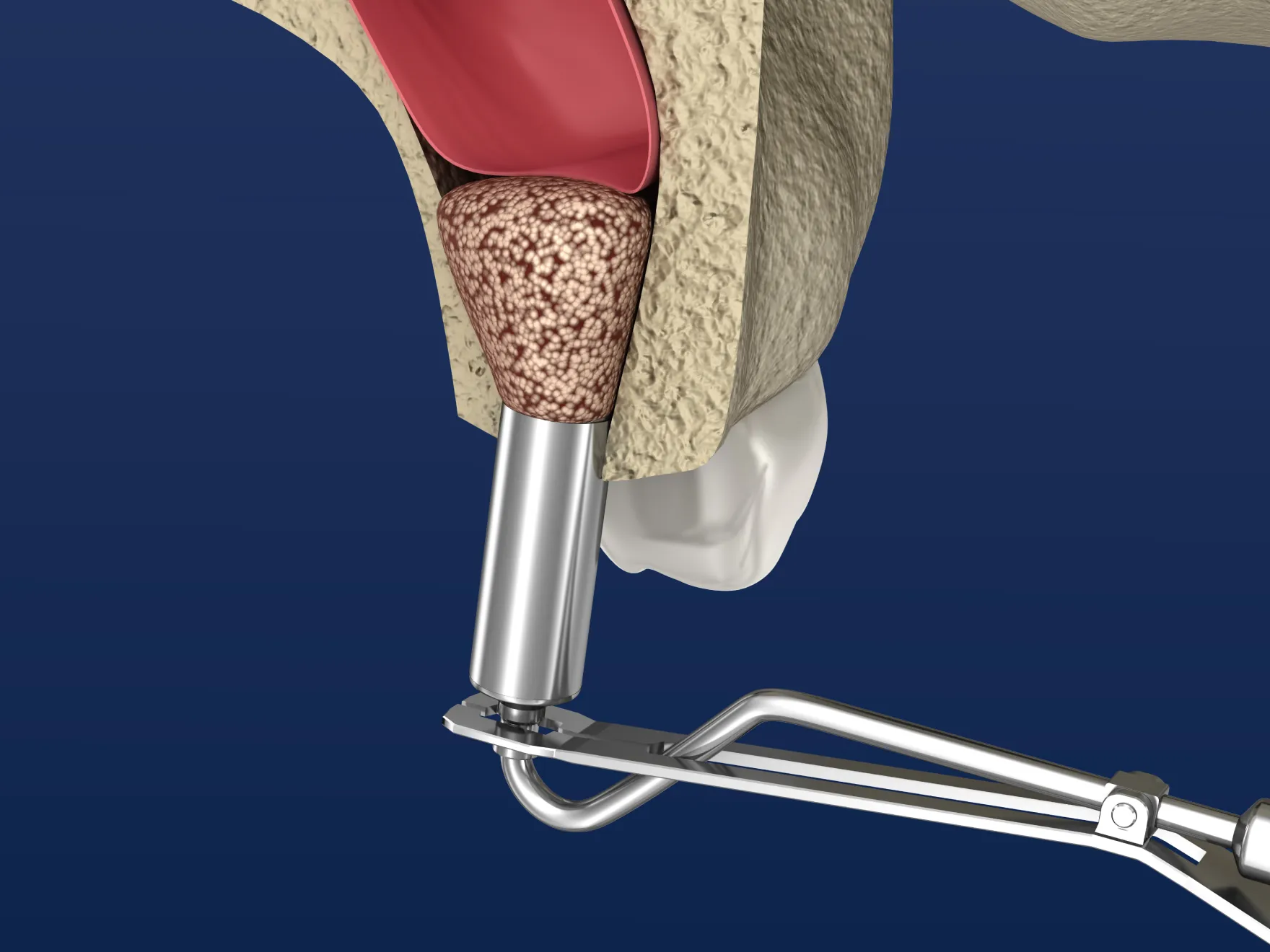 Sinus Lift Surgery in Wesley Chapel, FL | Graphic of the procedure