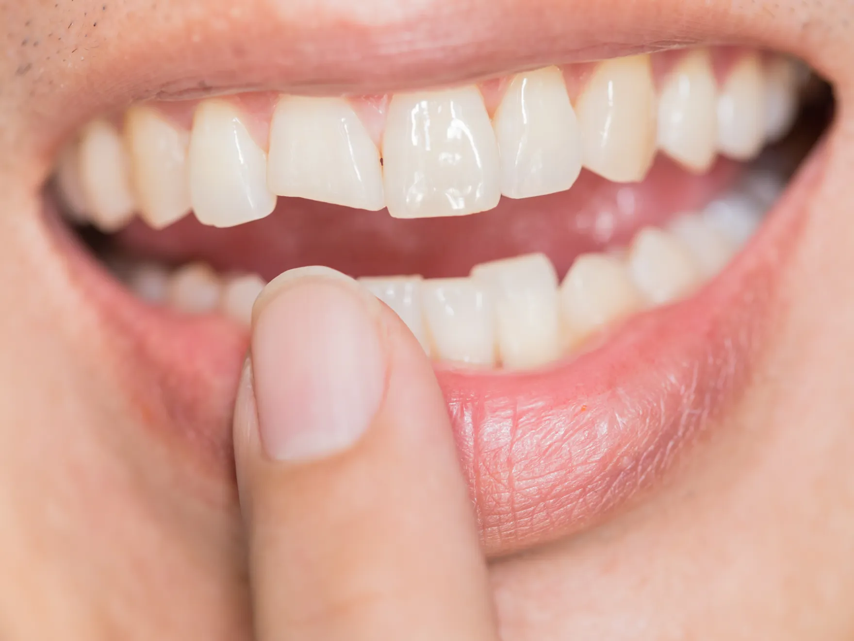 Cracked tooth