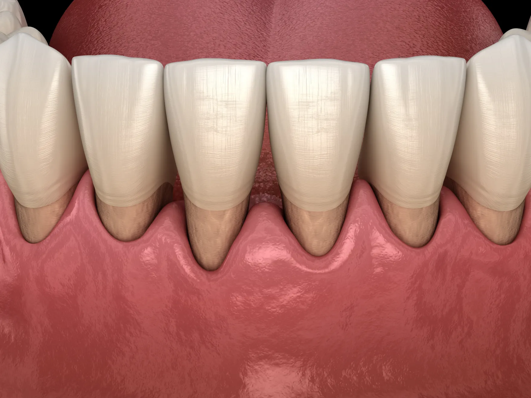 receeding gums