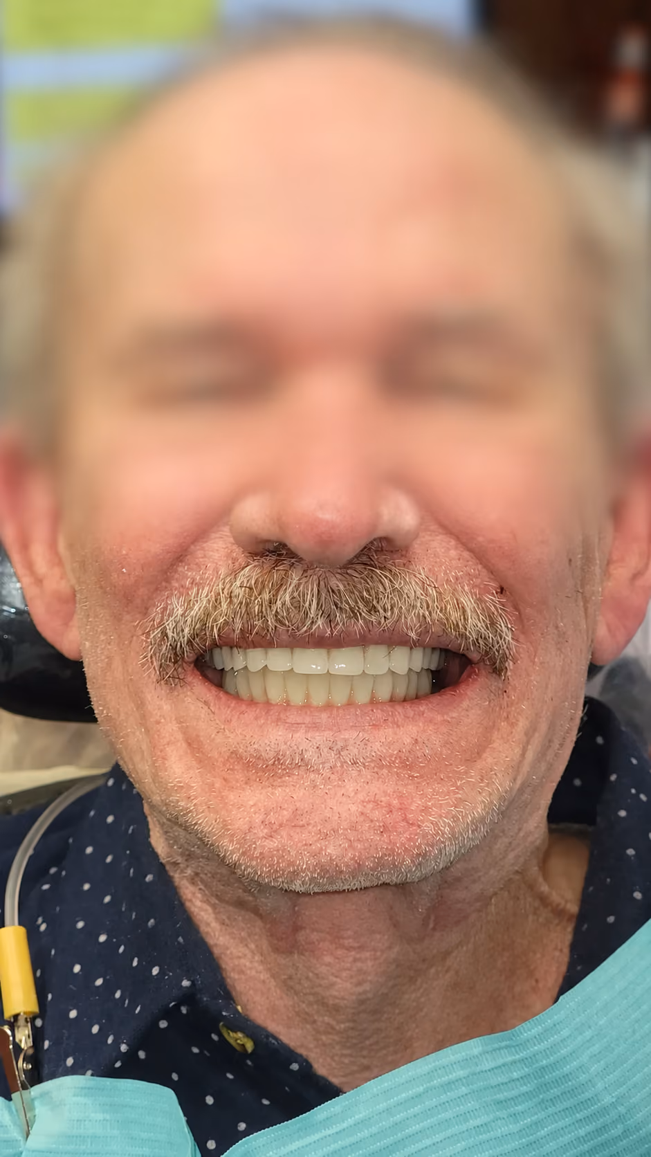 Patient new smile after full-arch implant treatment, face blurred for privacy