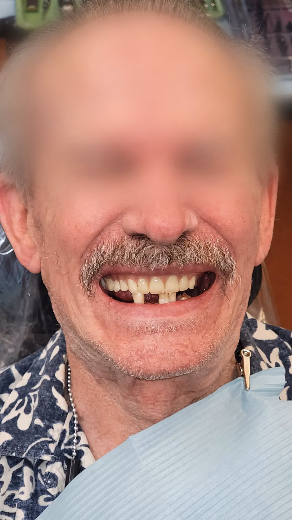 Patient with missing lower teeth before implant denture treatment, face blurred for privacy
