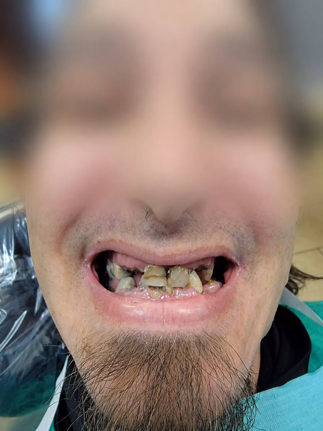 Patient with severely damaged teeth before full-mouth reconstruction, face blurred for privacy