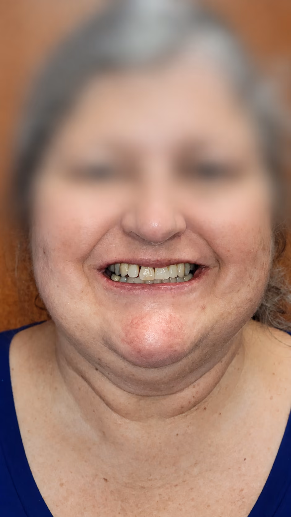 Patient with missing and damaged teeth before full-arch implant treatment at Apex Dental, face blurred for privacy