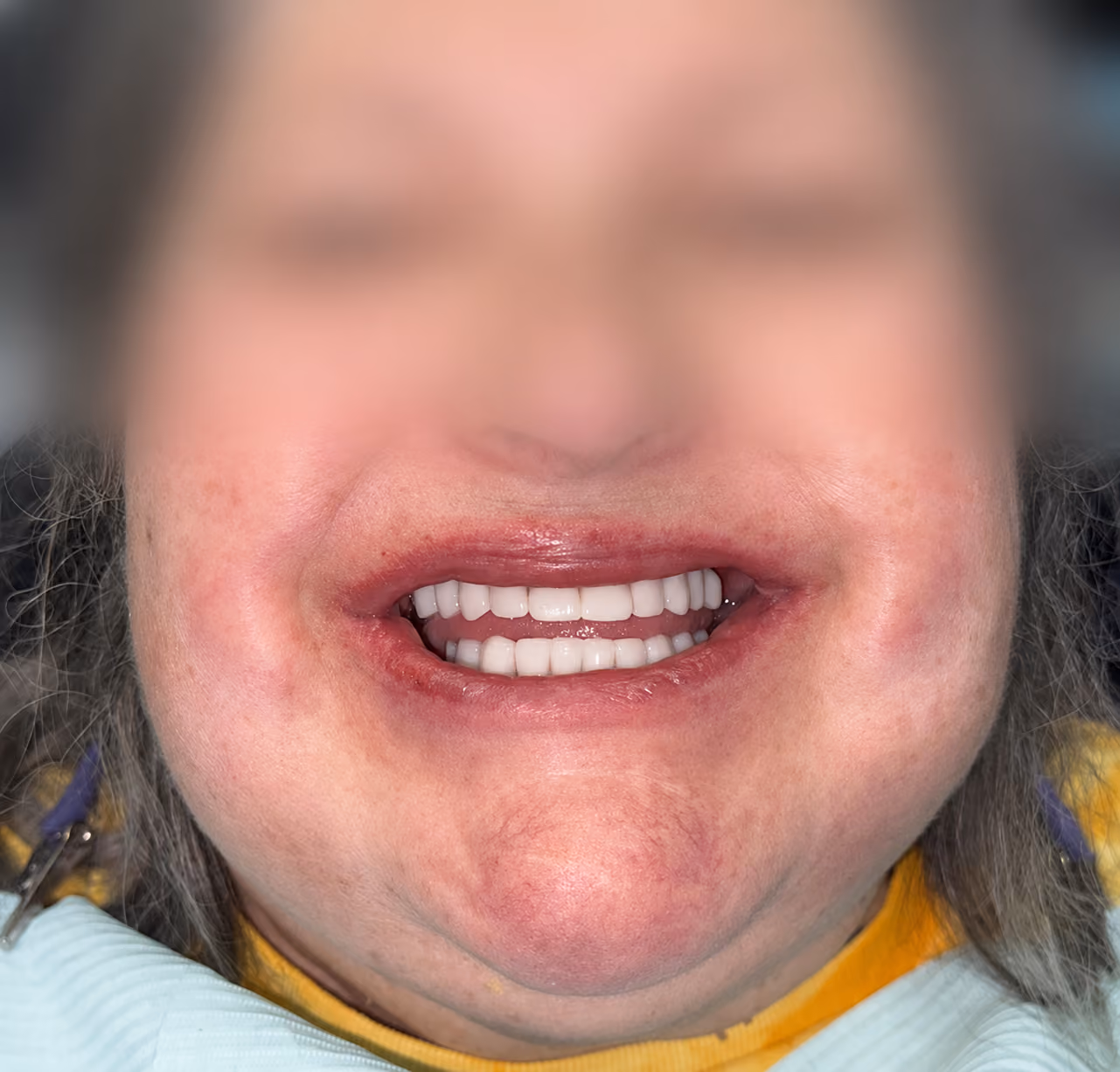 Patient new smile after full-arch implant treatment at Apex Dental, face blurred for privacy