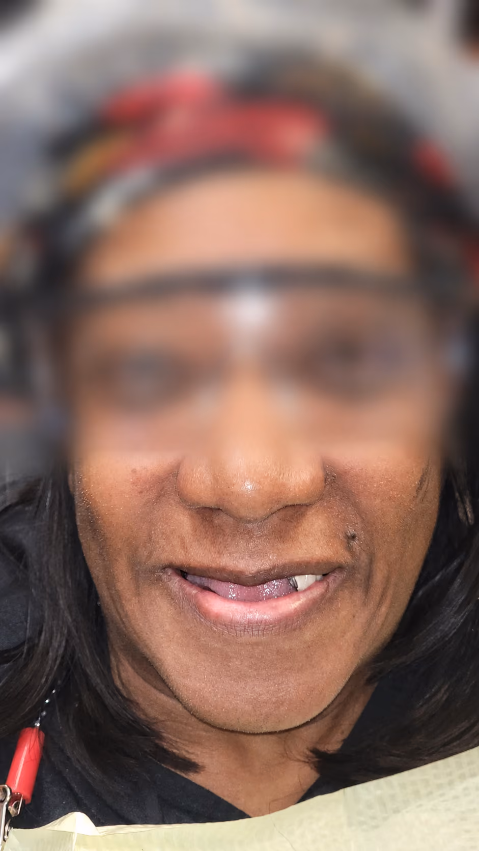 Patient with missing and damaged teeth before full-arch implant treatment at Apex Dental, face blurred for privacy