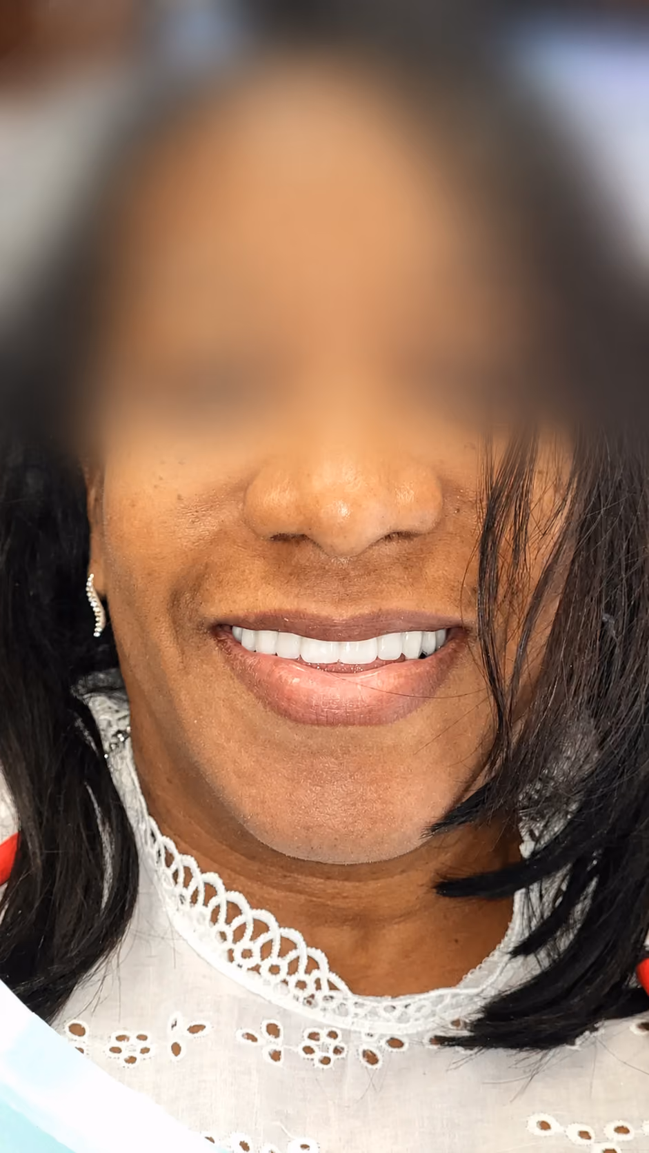 Patient new smile after full-arch implant treatment at Apex Dental, face blurred for privacy