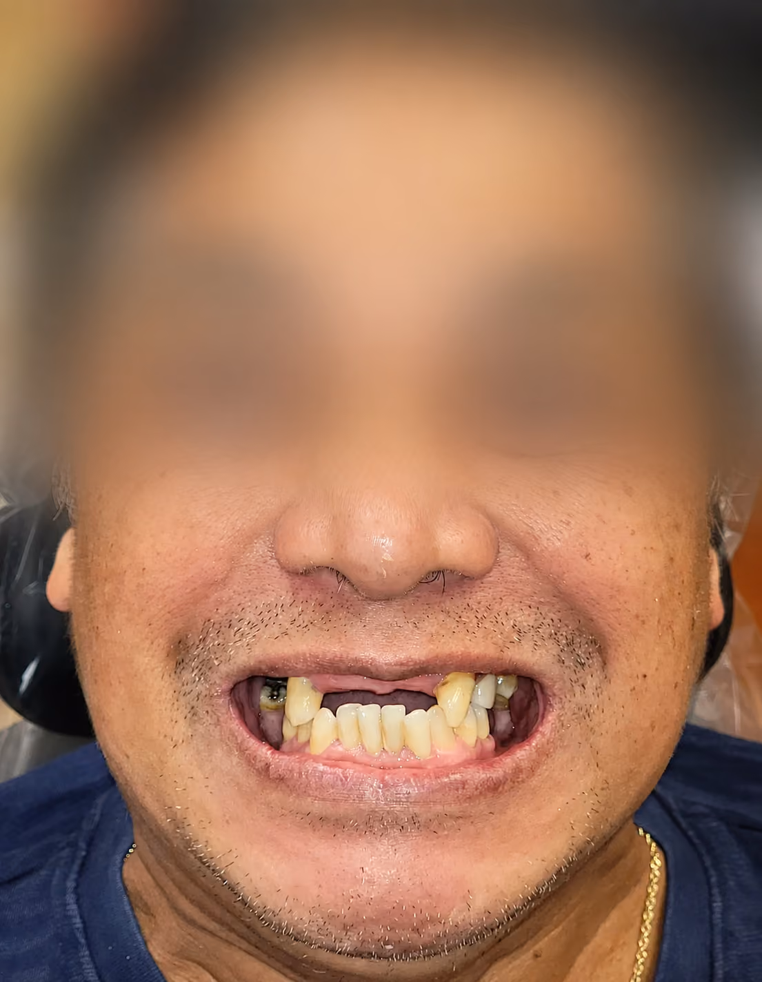 Patient with missing and discolored teeth before full-arch implant treatment at Apex Dental, face blurred for privacy