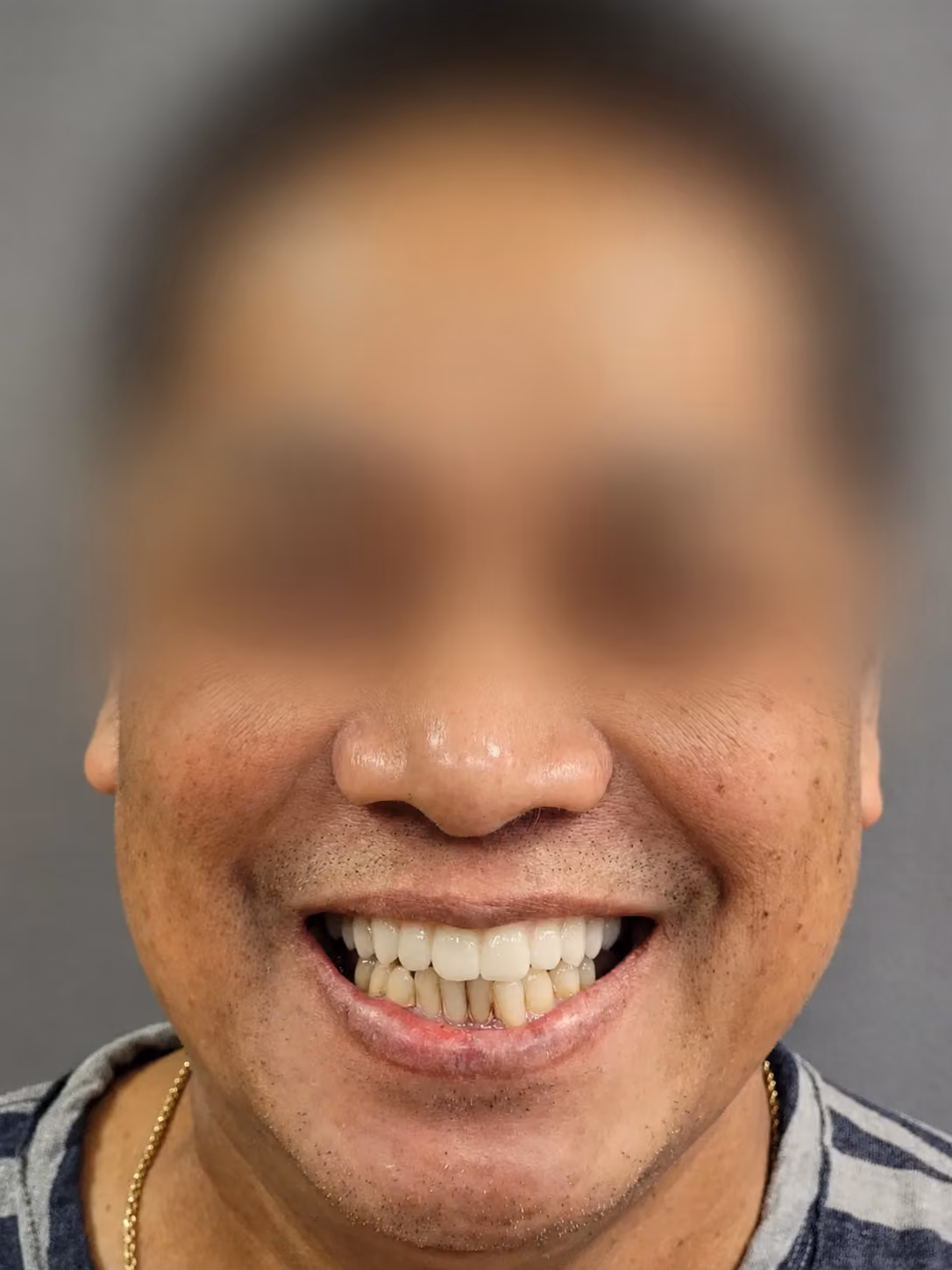 Patient new smile after full-arch implant treatment at Apex Dental, face blurred for privacy