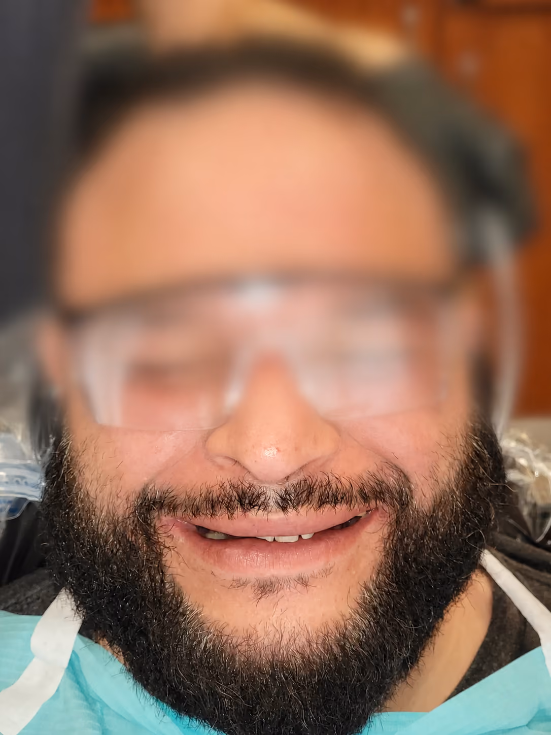 Patient with worn and damaged teeth before full-arch implant treatment at Apex Dental, face blurred for privacy