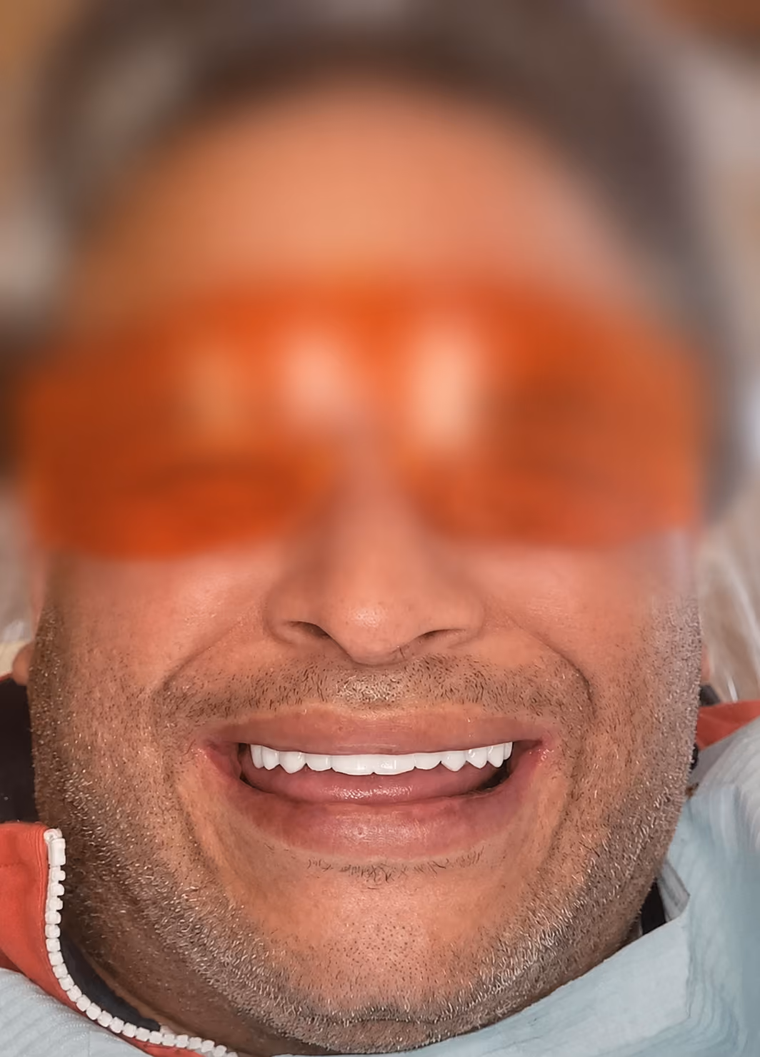 Patient new smile after full-arch implant treatment at Apex Dental, face blurred for privacy