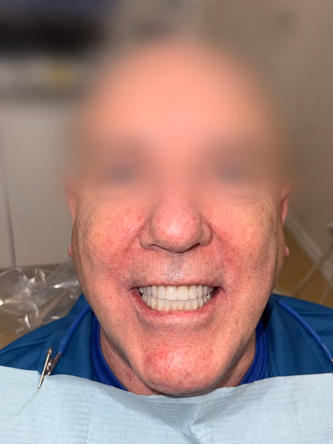 Patient new smile after full-arch implant treatment at Apex Dental, face blurred for privacy