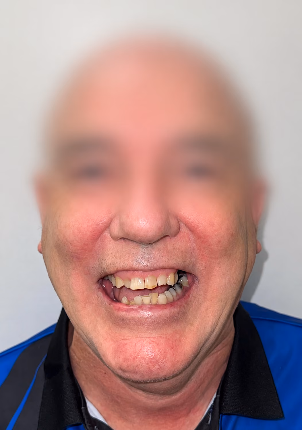 Patient with worn and discolored teeth before full-arch implant treatment at Apex Dental, face blurred for privacy