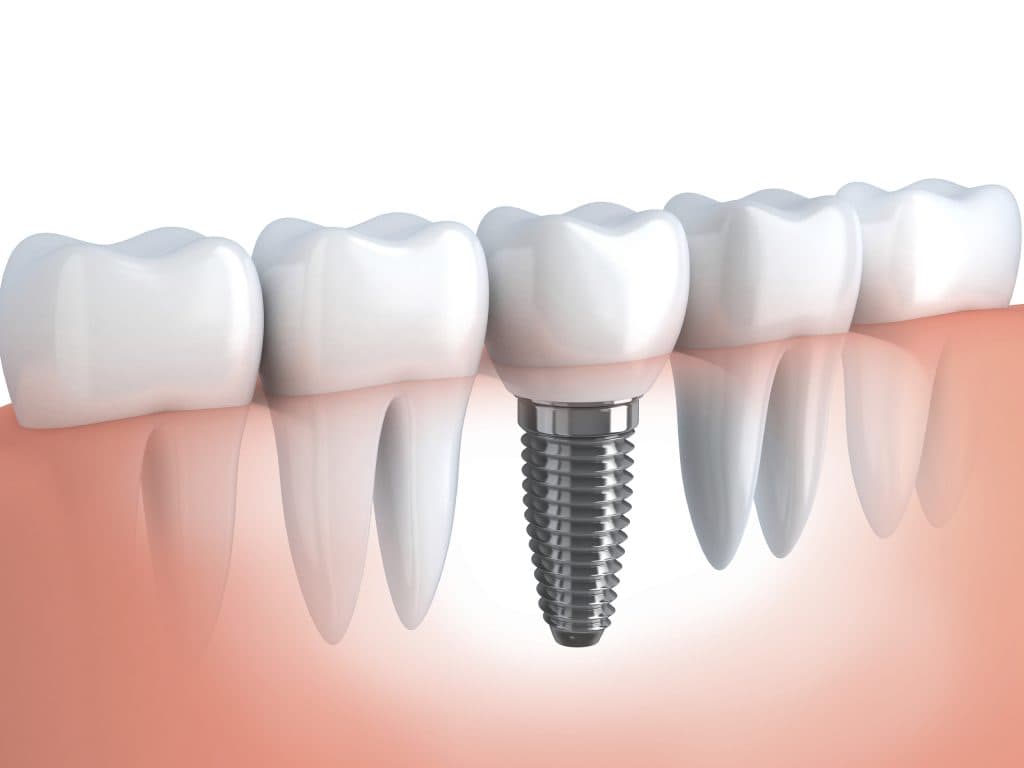 Tooth human implant
