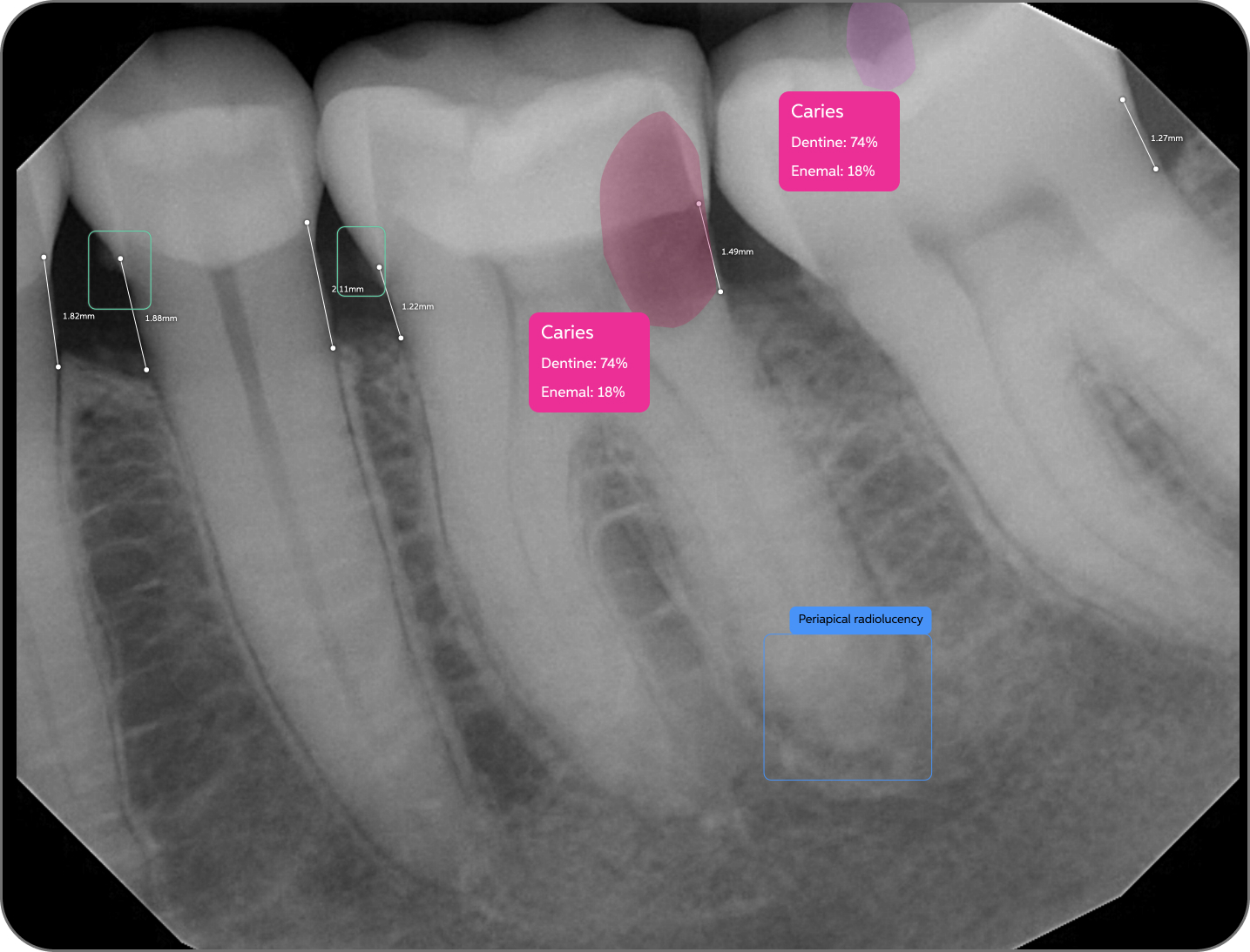 x-ray Second Opinion Carries and Periopical radiolucency