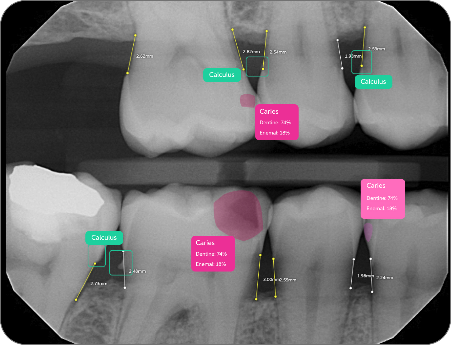 x-ray Second Opinion Carries and Calculus