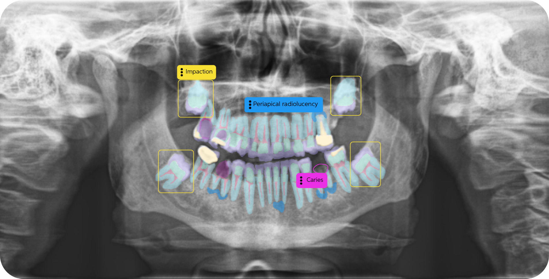 Pano Tooth Part Second Opinion