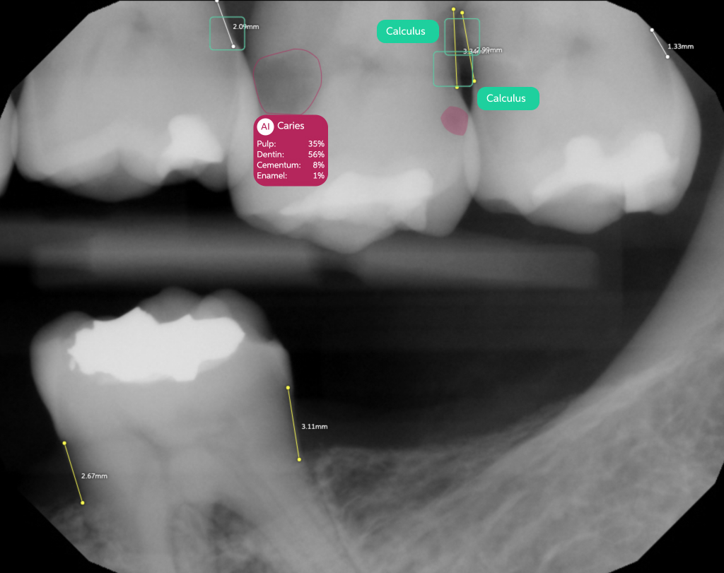 x-ray Second Opinion Carries and Calculus