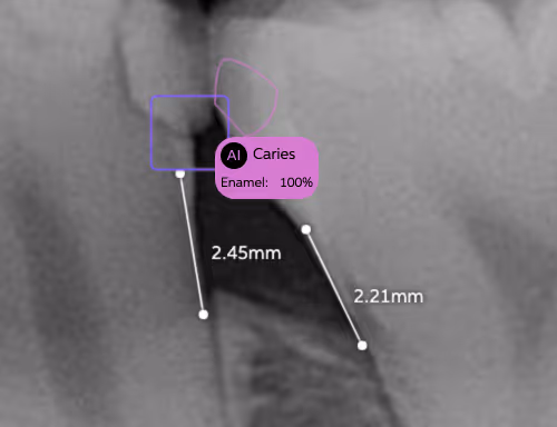 x-ray Second Opinion Notable Margin