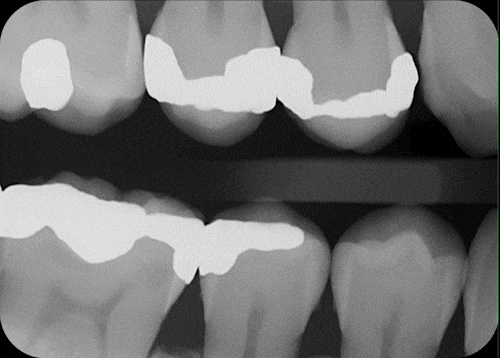 Dental AI reading a radiograph