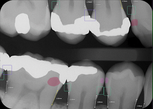 Dental AI reading a radiograph
