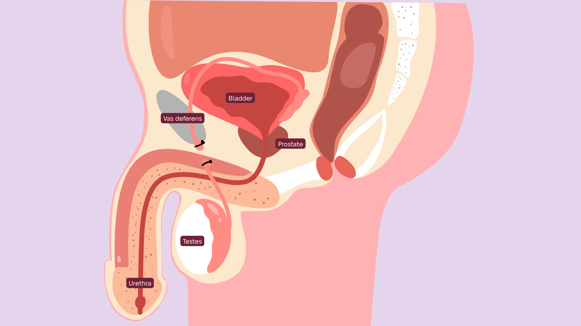 Medical illustration of male reproductive system cross-section showing bladder, prostate, testes, urethra, and vas deferens with clips on vas deferens.