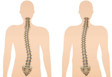 Illustration médicale montrant deux colonnes vertébrales avec scoliose adulte, vue de face, utilisée pour expliquer les traitements en ostéopathie à Montréal