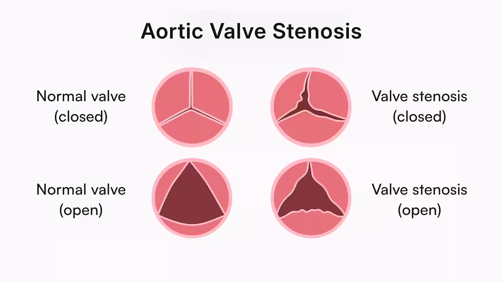 Images of aortic valve showing normal vs stenosis state.
