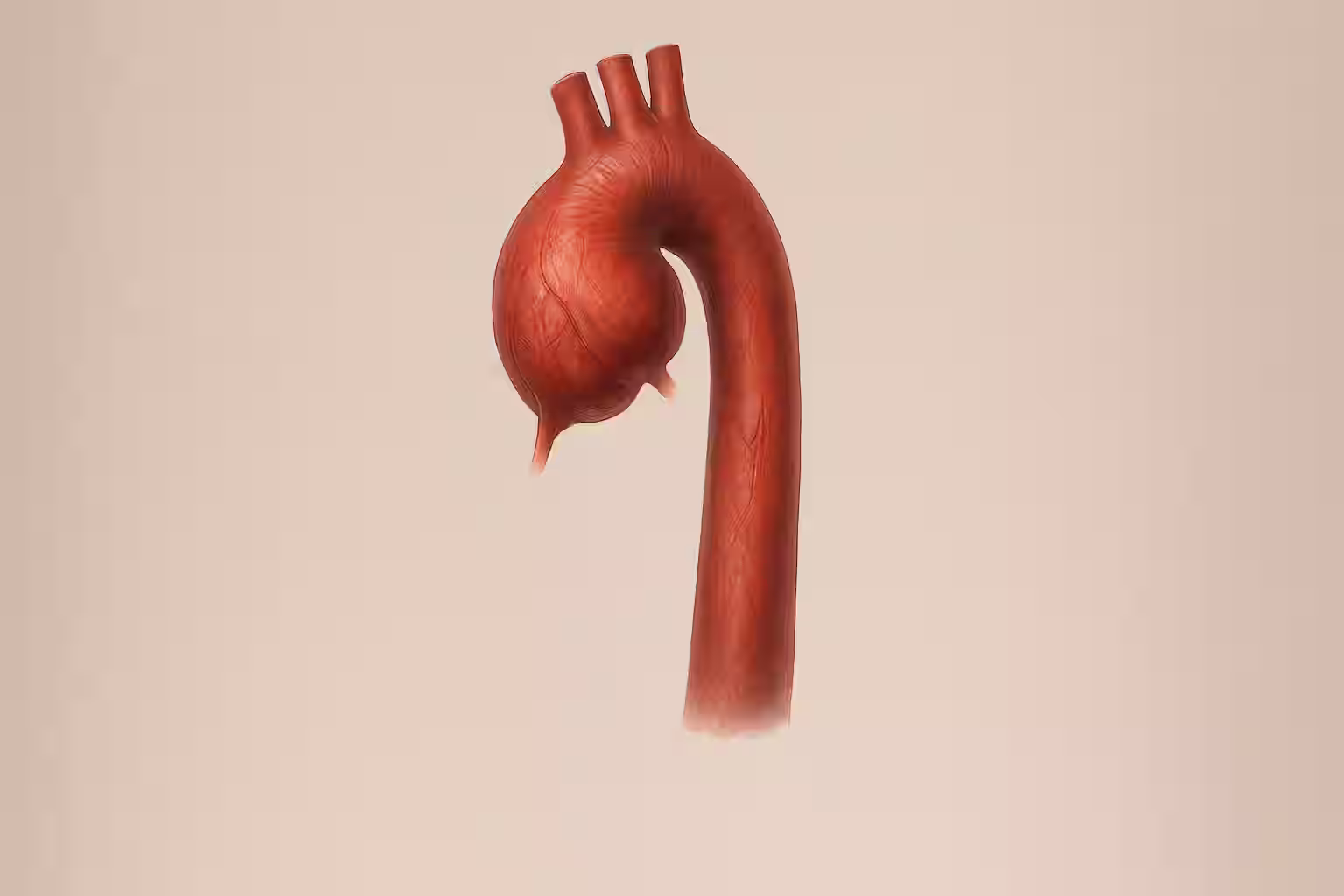 Image showing ascending aortic aneurysm