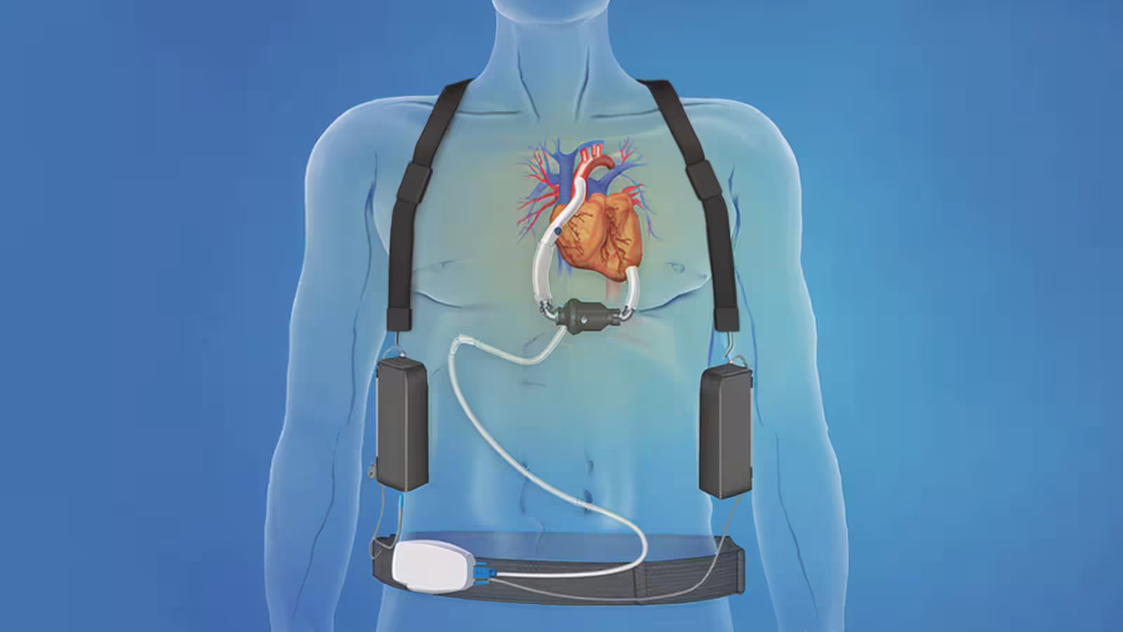 Image showing a male torso and heart, attached to a left ventricular assist device - LVAD
