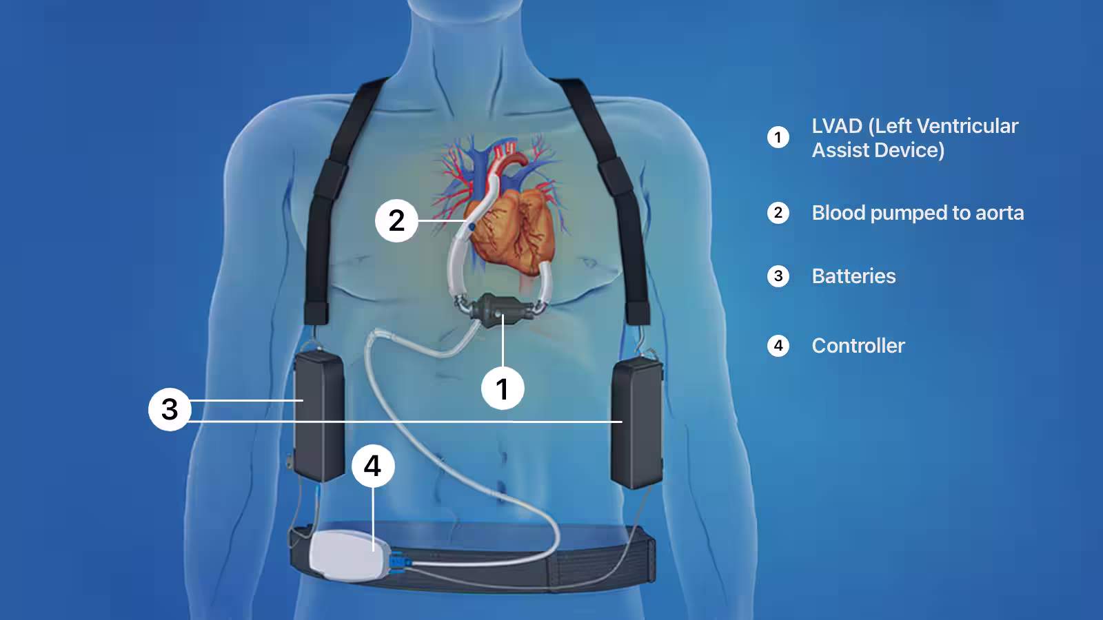 Image showing a male torso and heart, attached to a left ventricular assist device - LVAD