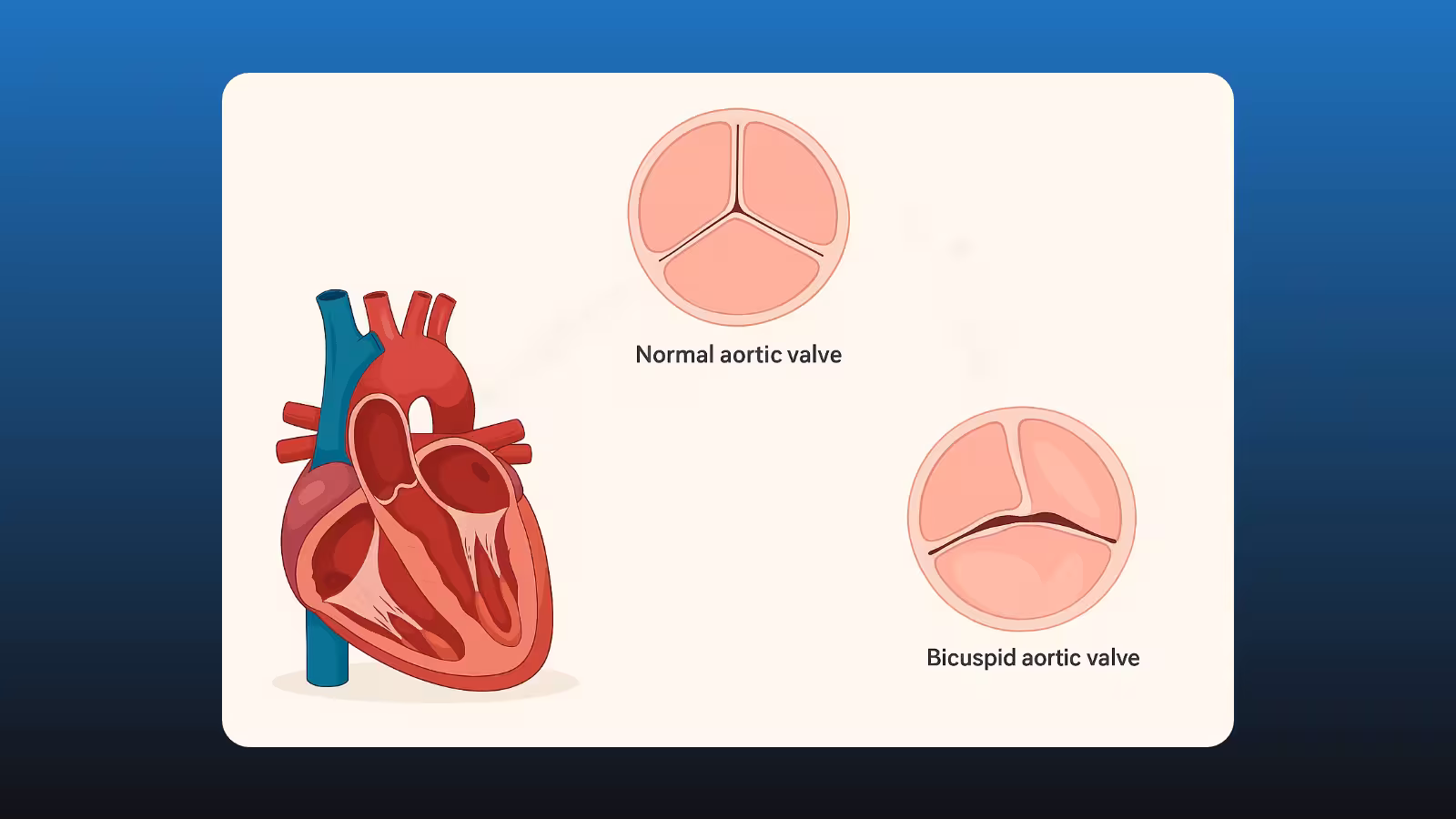 Illustration of cross section of a heart, a tricuspid valve and a bicuspid valve.