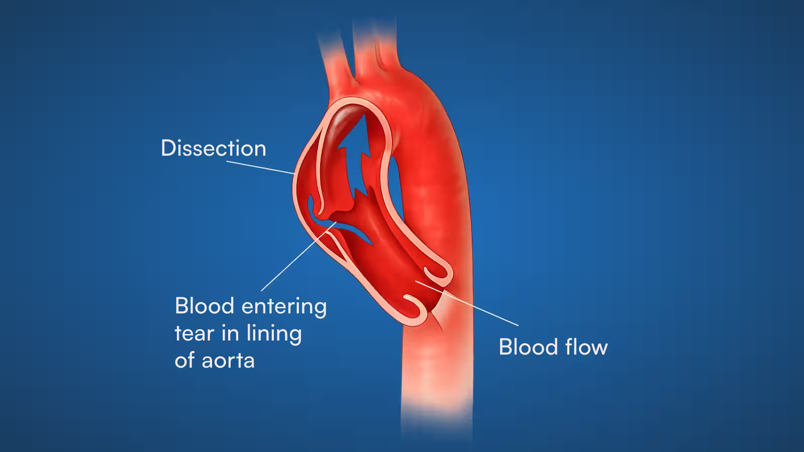 Aortic Dissection