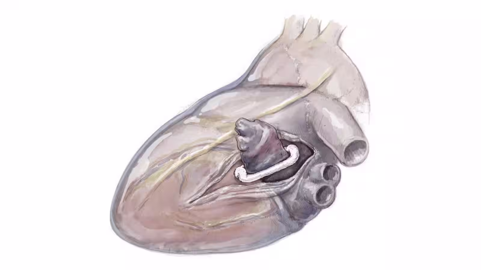 AtriClip Heart Illustration