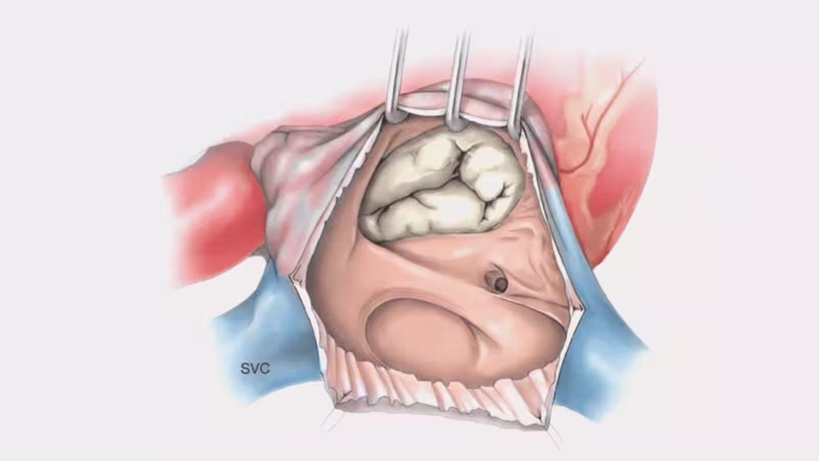 Medical illustration of cardiac surgery showing atrial myxoma tumor removal from heart chamber with surgical retractors and superior vena cava (SVC) labeled, demonstrating open heart surgical technique for cardiac tumor excision