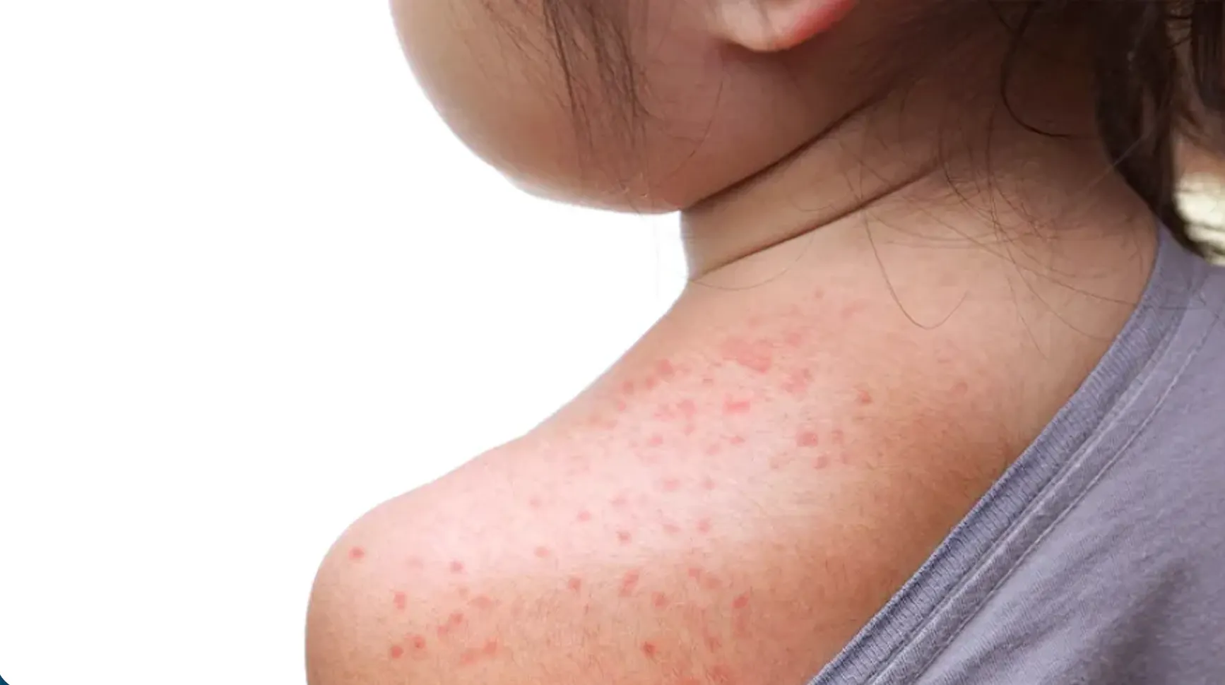 What you need to know about measles