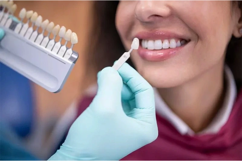 Teeth whitening