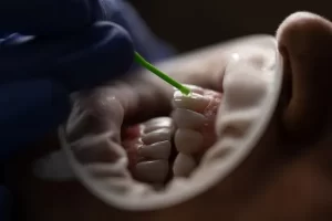 Dentist hand wearing black gloves, holding a green little plastic stick applying professional teeth whitening solution on patient's teeth.