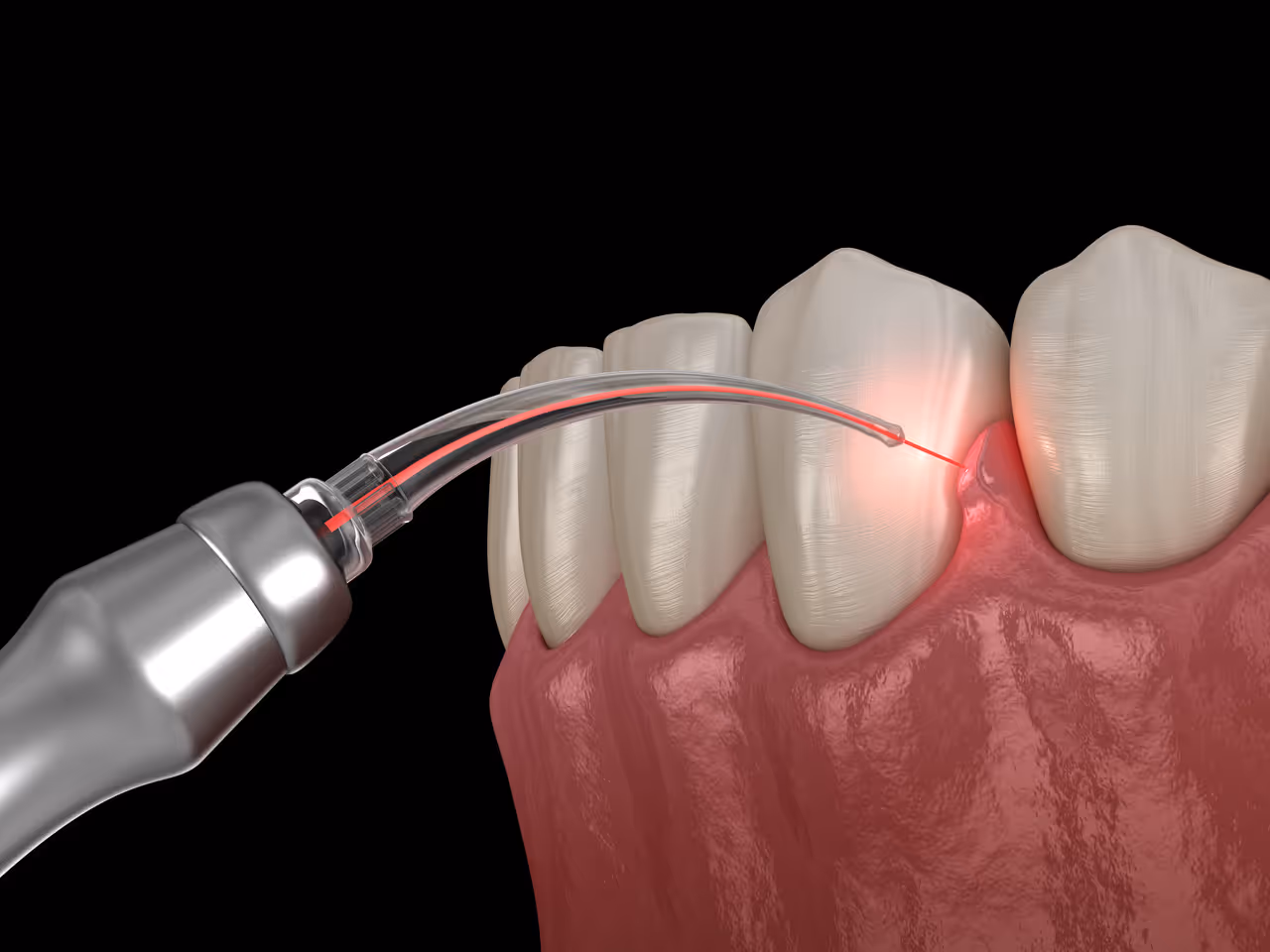 Laser Dentistry in Palo Alto, CA