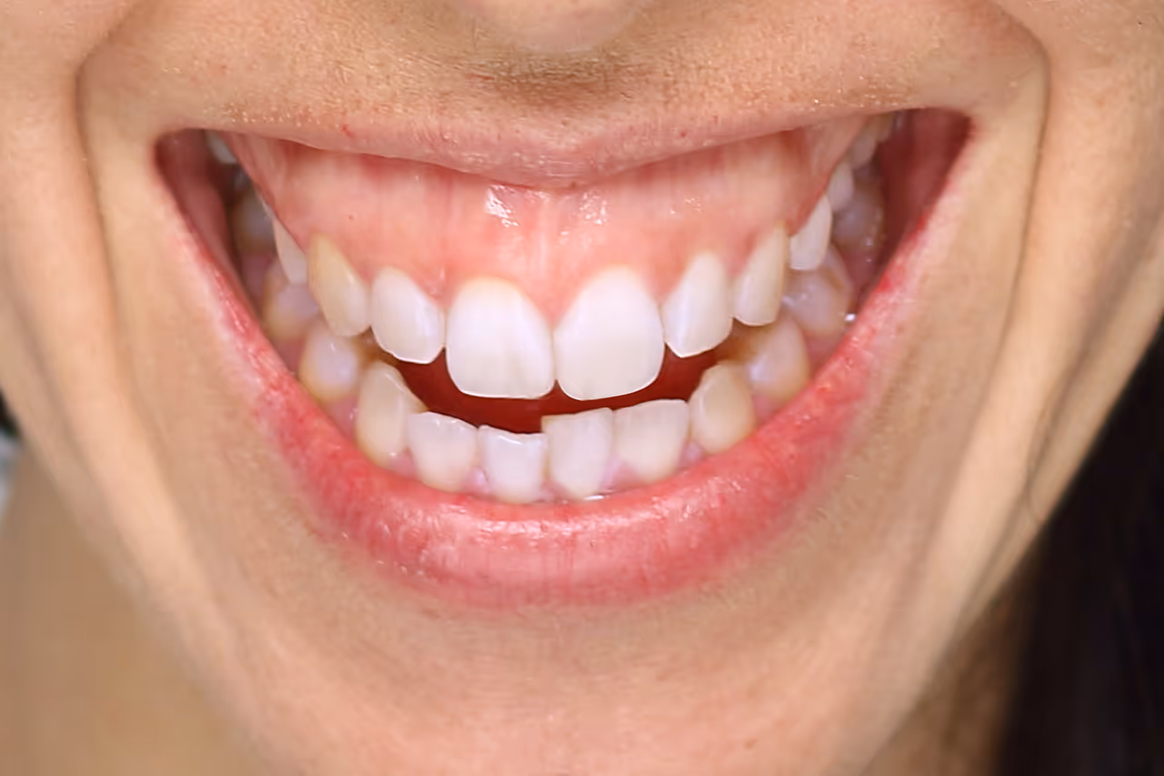 Gummy Smile Treatment in Palo Alto, CA