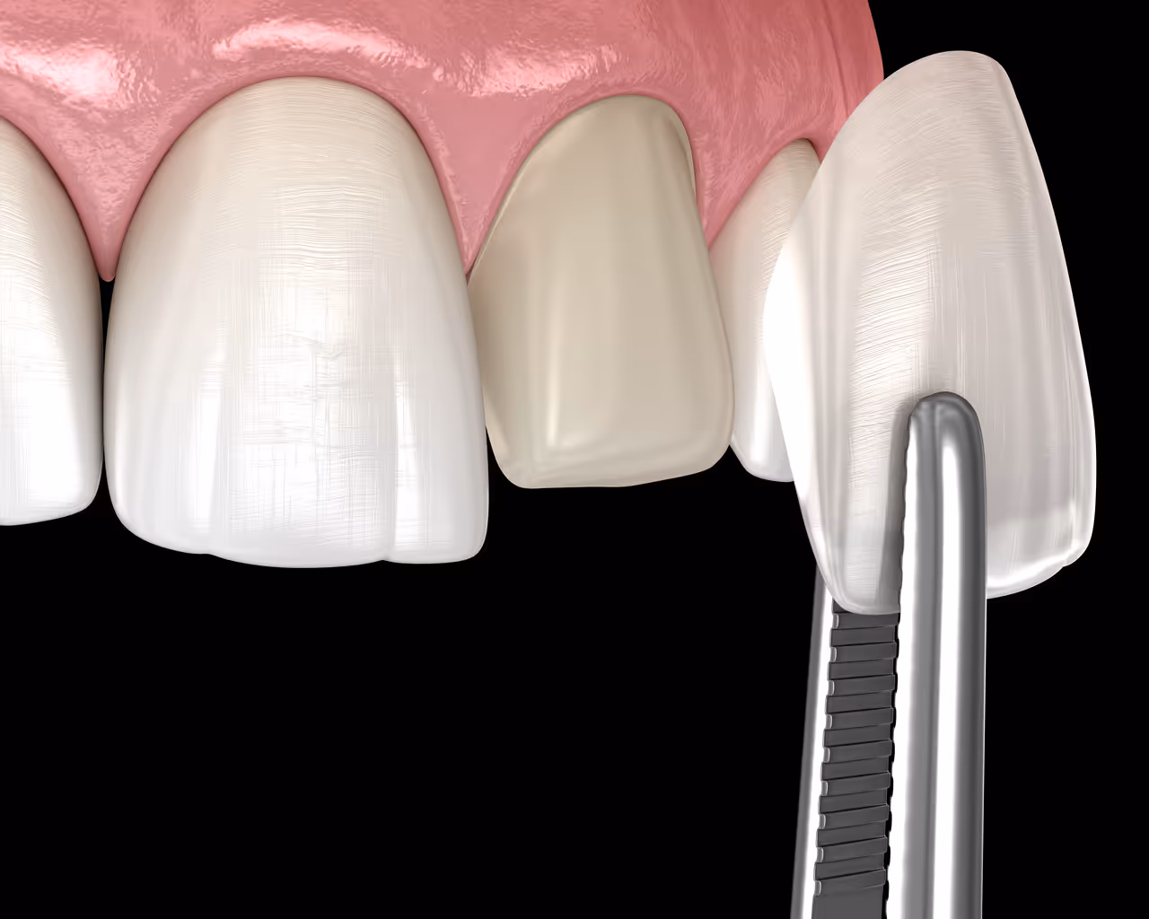 Dental Veneers in Palo Alto, CA