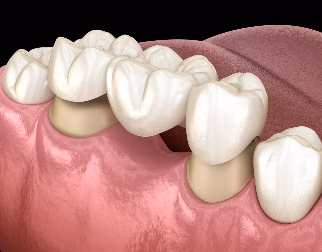 Dental Bridges in Palo Alto, CA