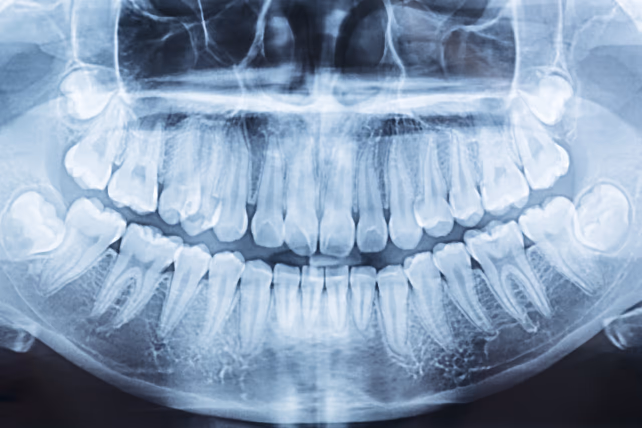 Digital X-rays