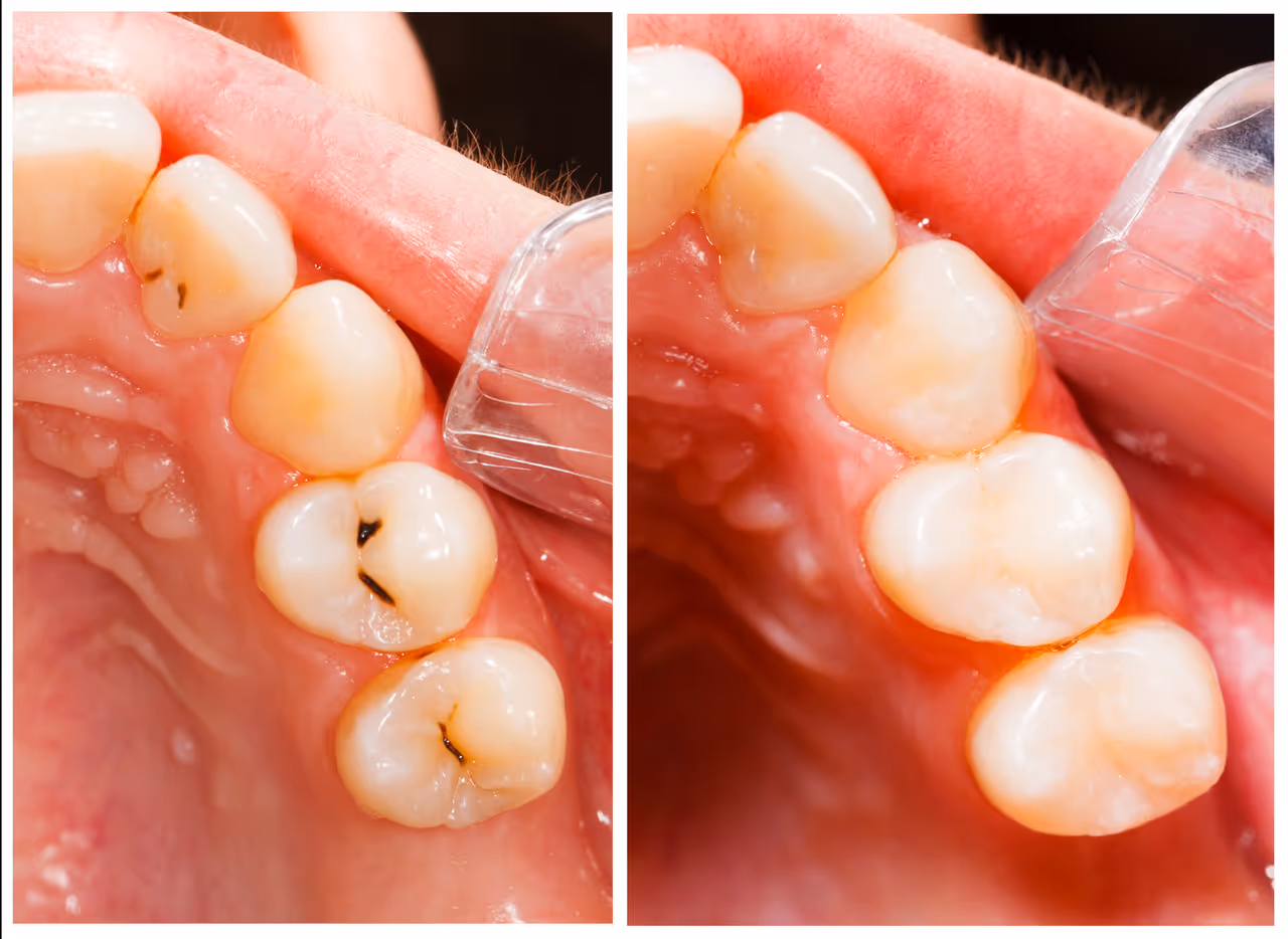 Dental Fillings