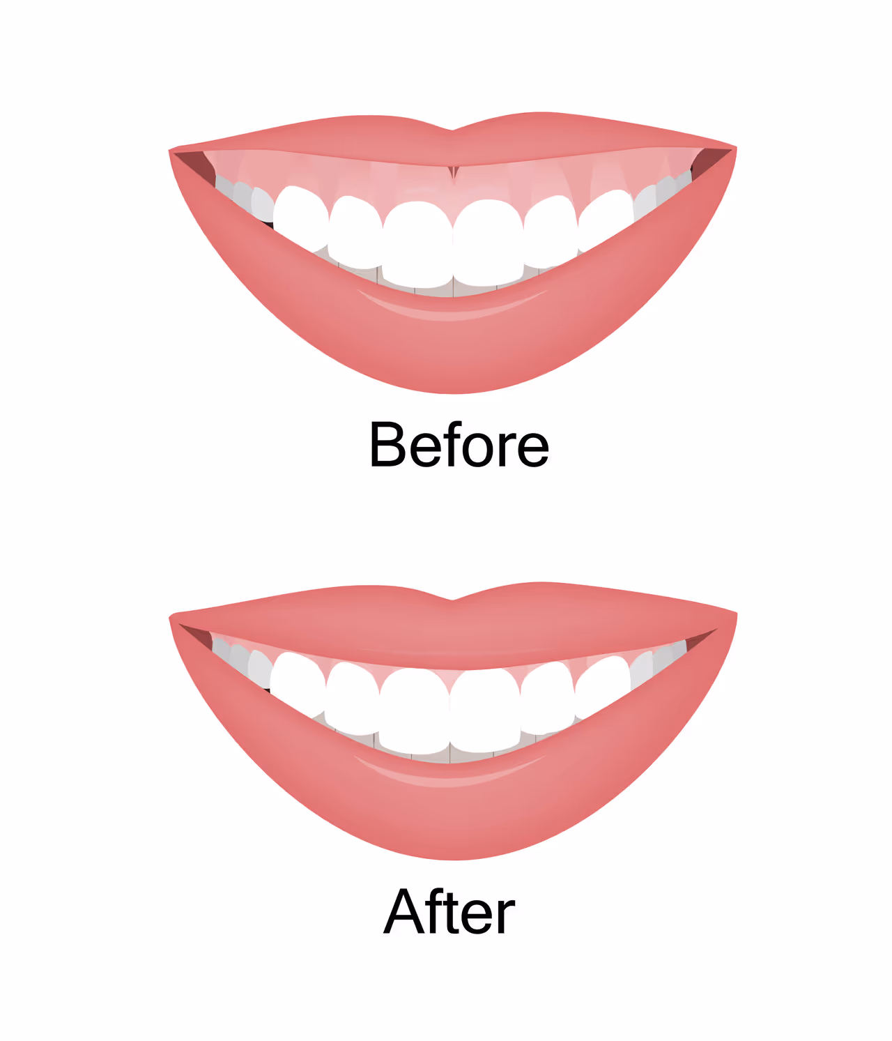 Gummy Smile Treatment