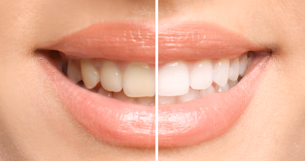 Zoom Teeth Whitening