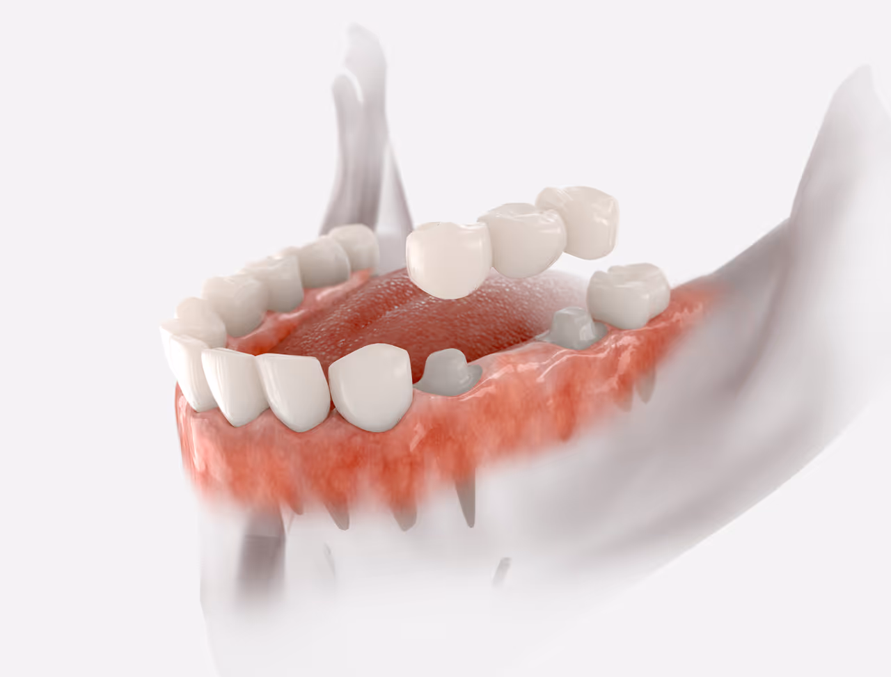 Dental Bridges