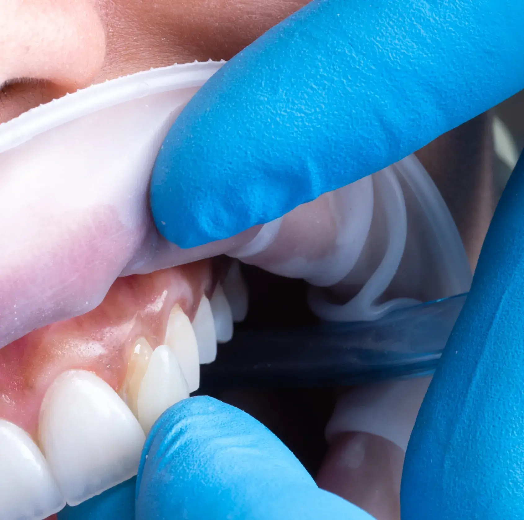 Close-up of a dentist wearing blue gloves examining a patient's teeth and gums.