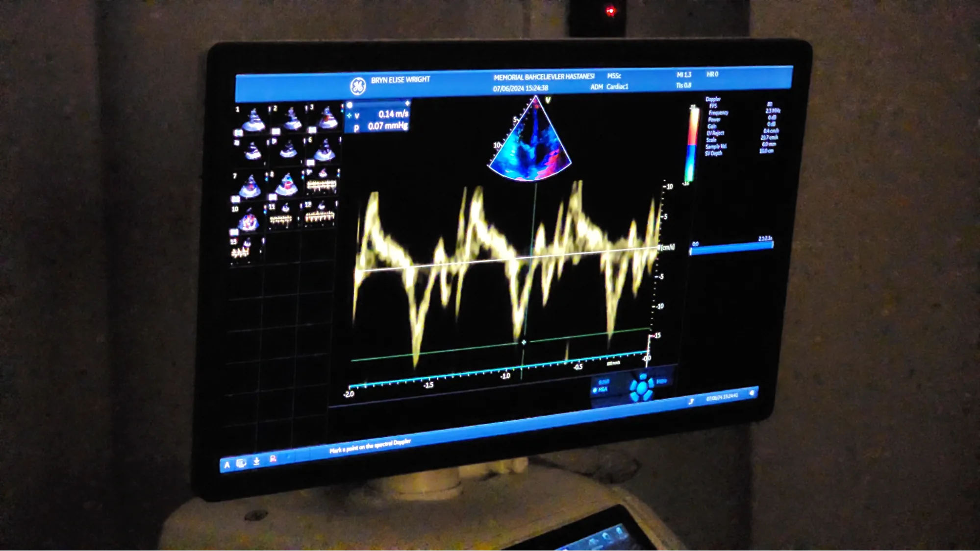 Echocardiogram waveform results on screen