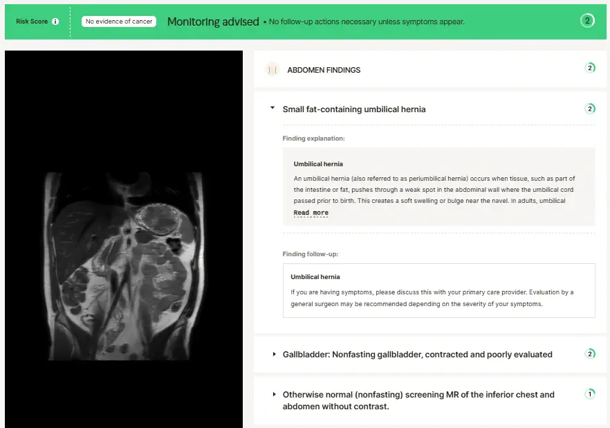MRI abdomen scan showing findings of a small fat-containing umbilical hernia with medical report details on screen.