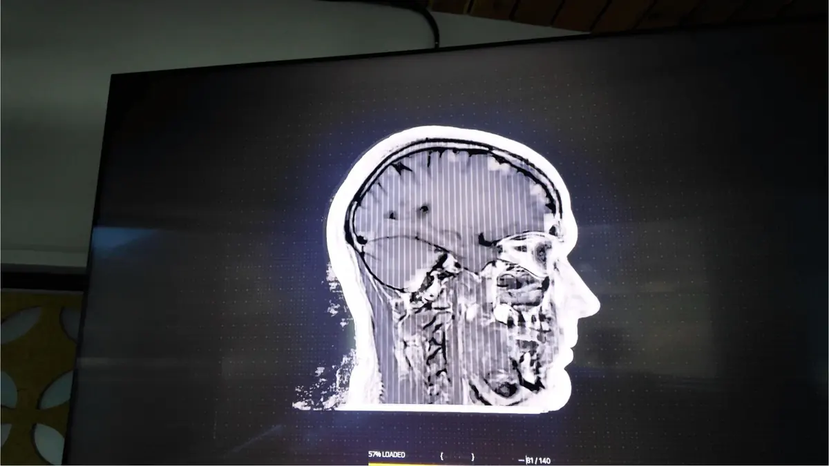 Side profile MRI brain scan showing detailed cross-sectional view of the head and brain structure on a medical display.